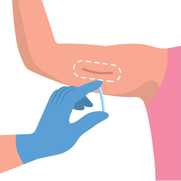 contraceptive-implant-birth-control-illustration-600nw-2403997027