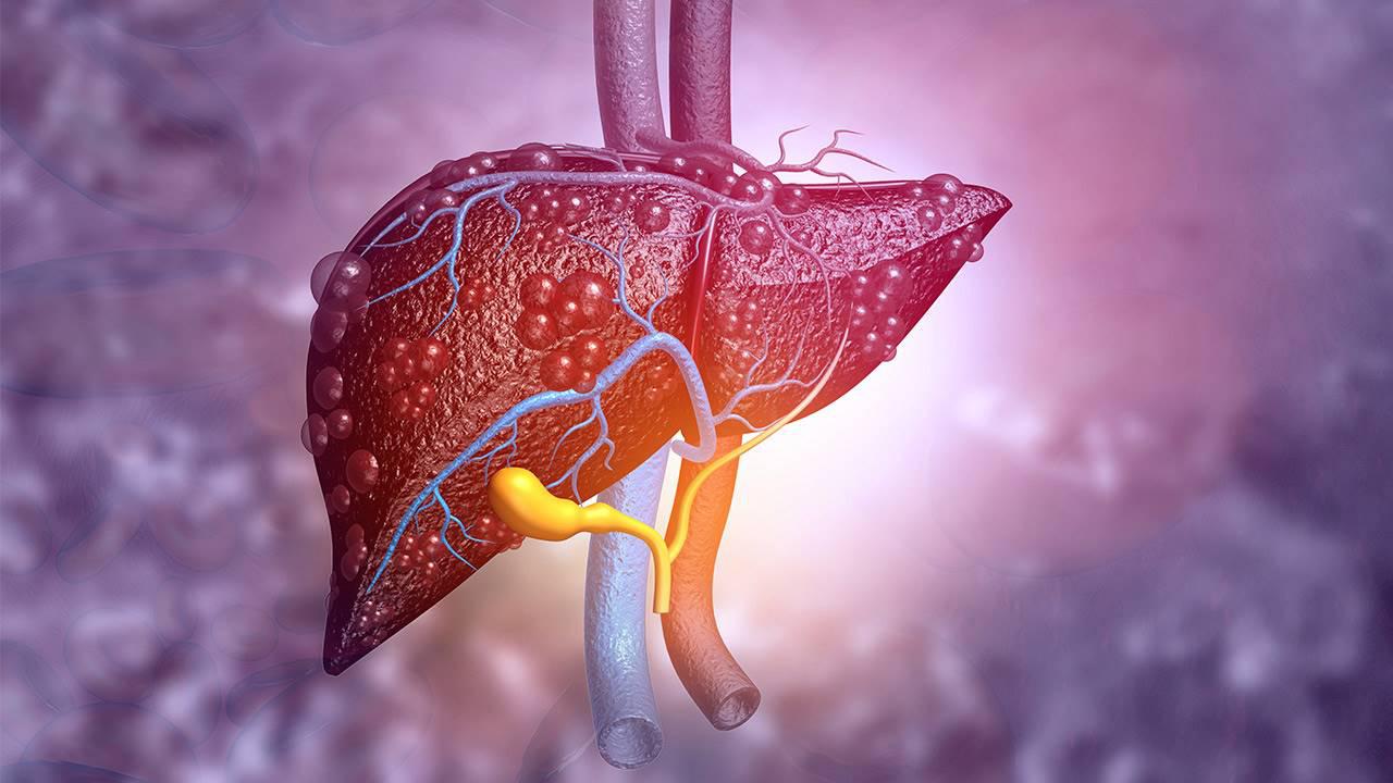 hepatitis